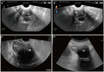 Ultrasonographic manifestations and misdiagnosis analysis of ovarian leiomyoma